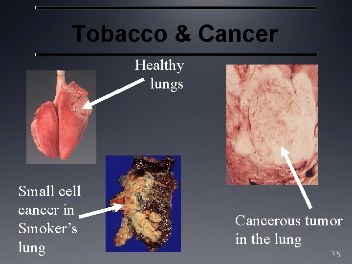 Tobacco & Cancer Healthy lungs Small cell cancer in Smoker’s lung Cancerous tumor in