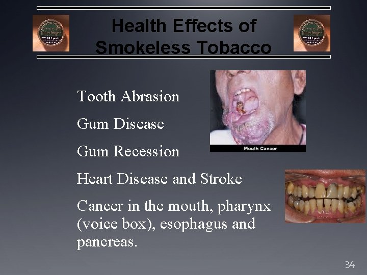 Health Effects of Smokeless Tobacco Tooth Abrasion Gum Disease Gum Recession Heart Disease and