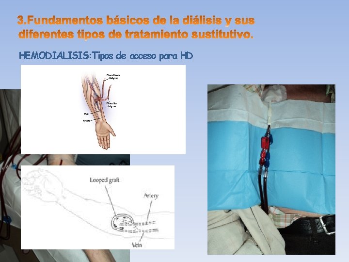 HEMODIALISIS: Tipos de acceso para HD 