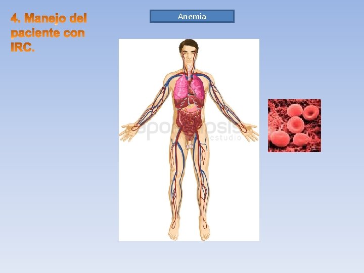 Anemia 