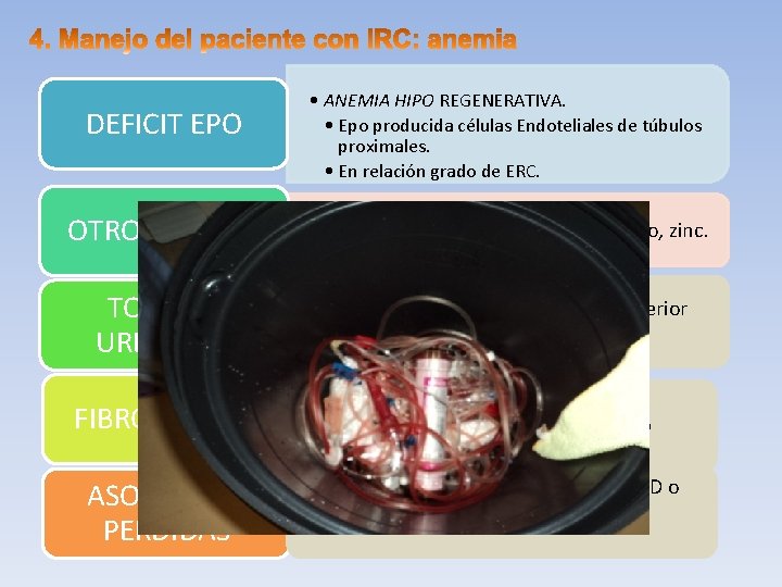DEFICIT EPO • ANEMIA HIPO REGENERATIVA. • Epo producida células Endoteliales de túbulos proximales.