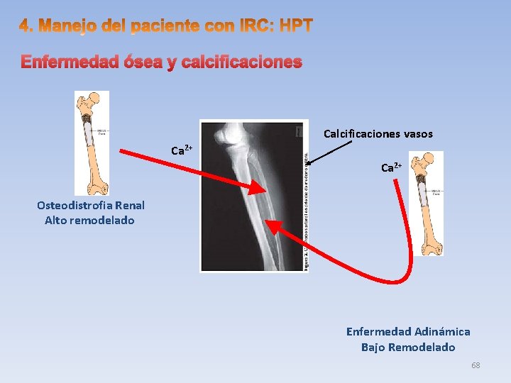 Enfermedad ósea y calcificaciones Calcificaciones vasos Ca 2+ Osteodistrofia Renal Alto remodelado Enfermedad Adinámica
