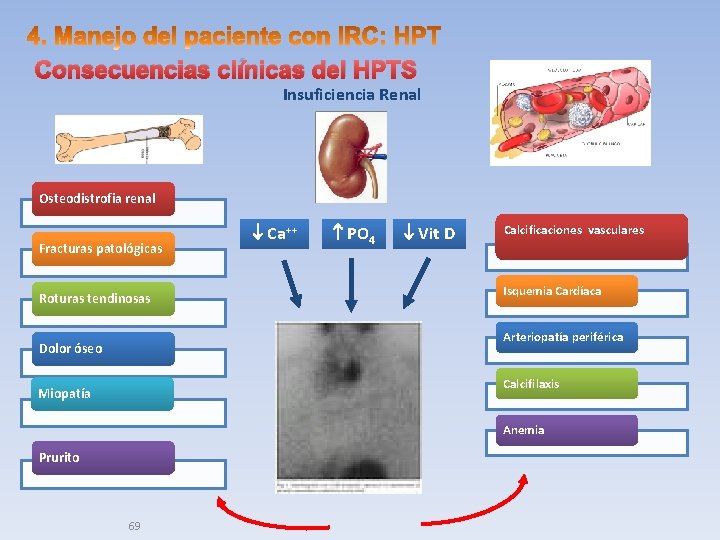 Consecuencias clínicas del HPTS Insuficiencia Renal Osteodistrofia renal Fracturas patológicas Ca++ PO 4 Calcificaciones