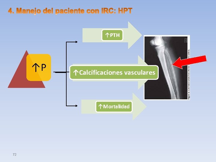 ↑PTH ↑P ↑Calcificaciones vasculares ↑Mortalidad 72 