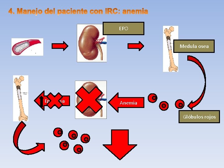 EPO Medula osea Epoetina Anemia Glóbulos rojos 