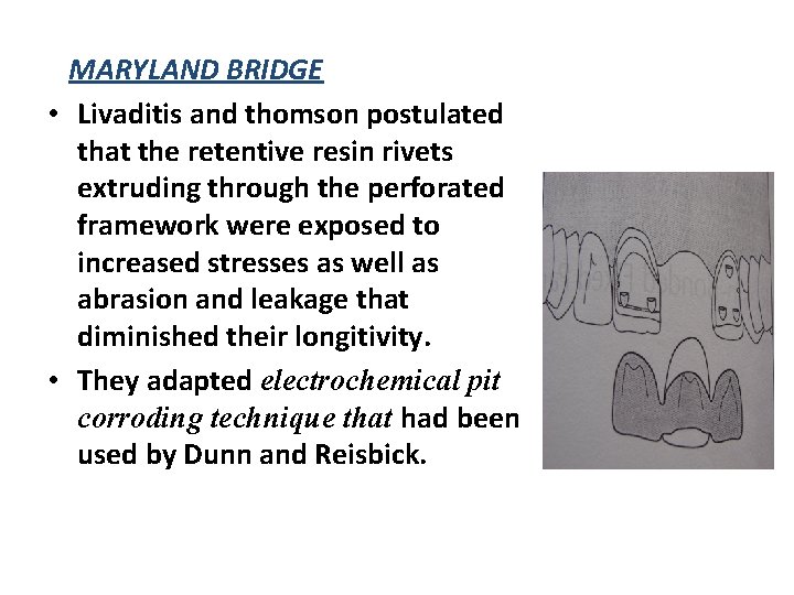 MARYLAND BRIDGE • Livaditis and thomson postulated that the retentive resin rivets extruding through