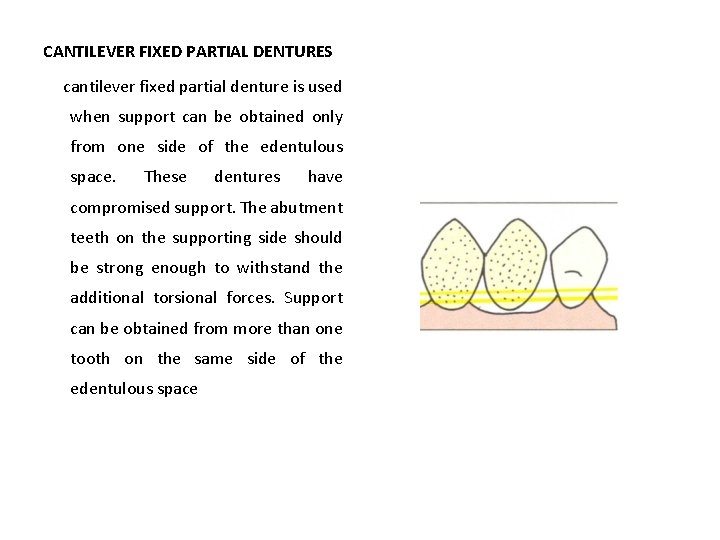 CANTILEVER FIXED PARTIAL DENTURES cantilever fixed partial denture is used when support can be