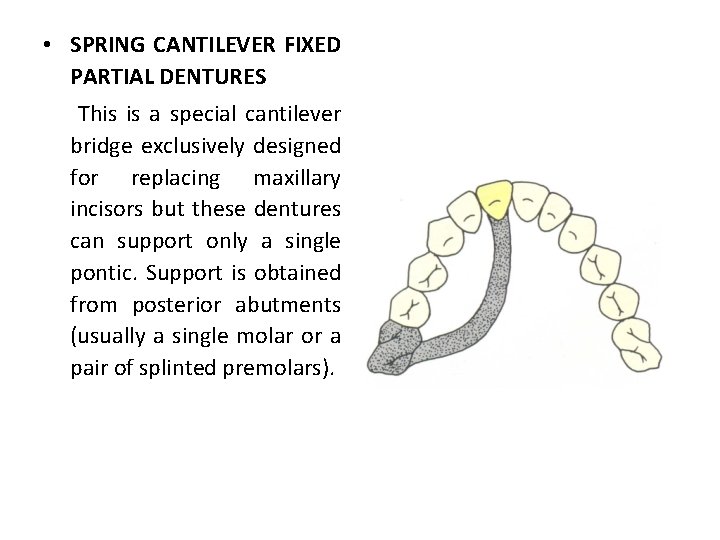  • SPRING CANTILEVER FIXED PARTIAL DENTURES This is a special cantilever bridge exclusively