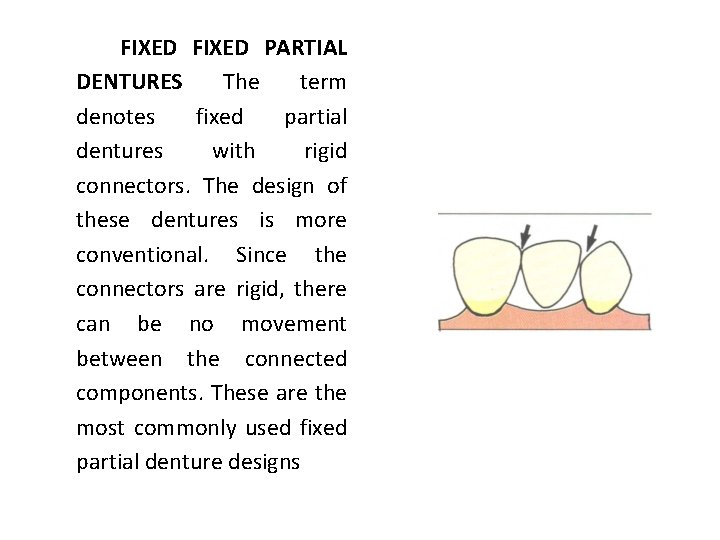 FIXED PARTIAL DENTURES The term denotes fixed partial dentures with rigid connectors. The design