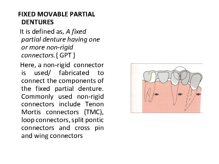 FIXED MOVABLE PARTIAL DENTURES It is defined as, A fixed partial denture having one