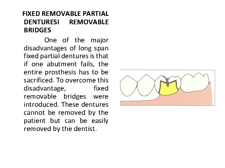 FIXED REMOVABLE PARTIAL DENTURESI REMOVABLE BRIDGES One of the major disadvantages of long span