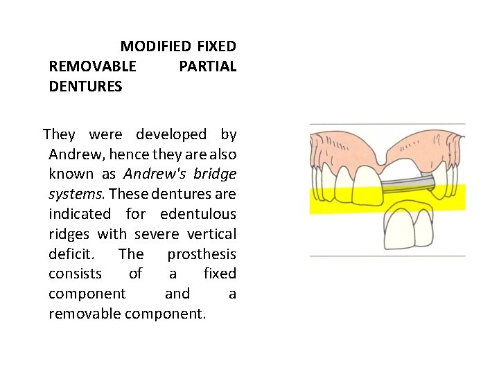 MODIFIED FIXED REMOVABLE PARTIAL DENTURES They were developed by Andrew, hence they are also