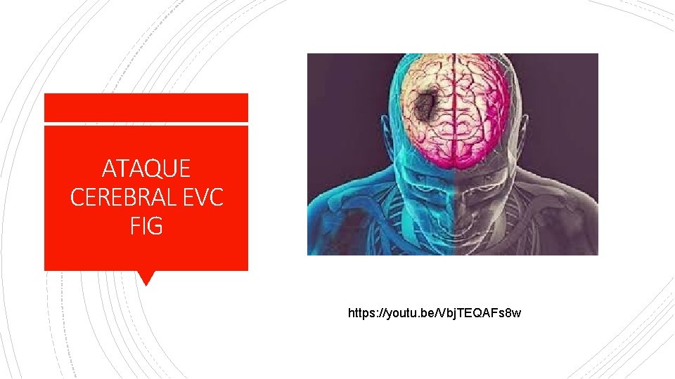 ATAQUE CEREBRAL EVC FIG https: //youtu. be/Vbj. TEQAFs 8 w 