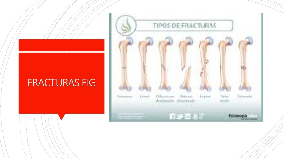 FRACTURAS FIG 