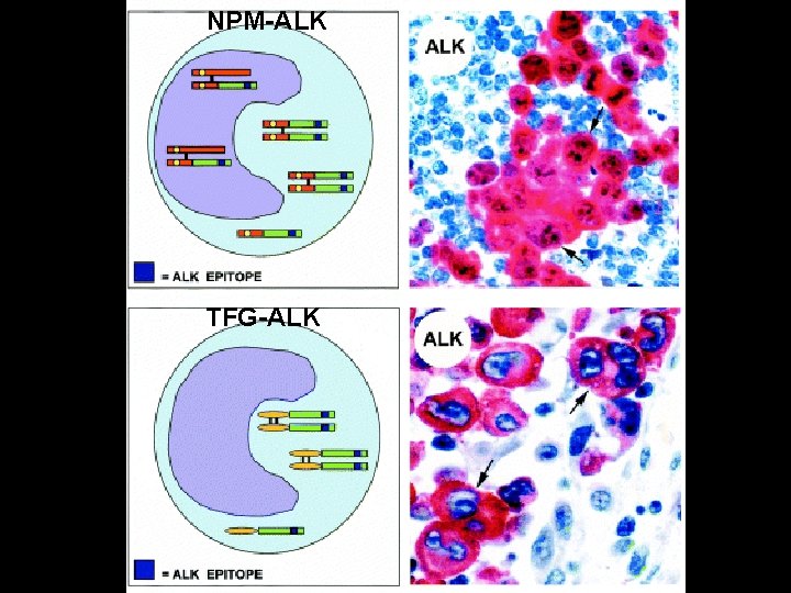NPM-ALK TFG-ALK 