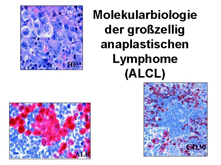 HE Molekularbiologie der großzellig anaplastischen Lymphome (ALCL) 