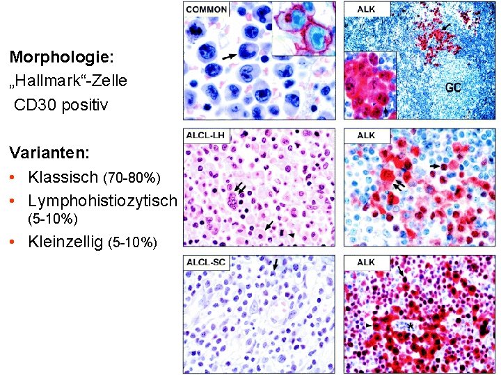 Morphologie: „Hallmark“-Zelle CD 30 positiv Varianten: • Klassisch (70 -80%) • Lymphohistiozytisch (5 -10%)