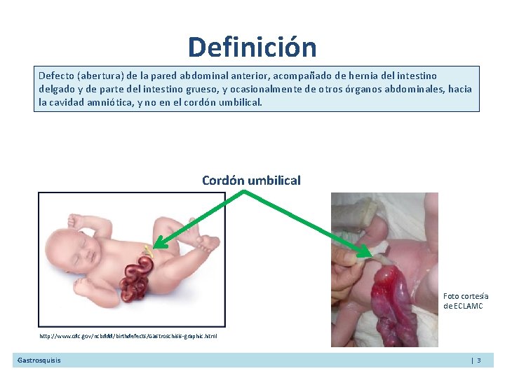 Definición Defecto (abertura) de la pared abdominal anterior, acompañado de hernia del intestino delgado