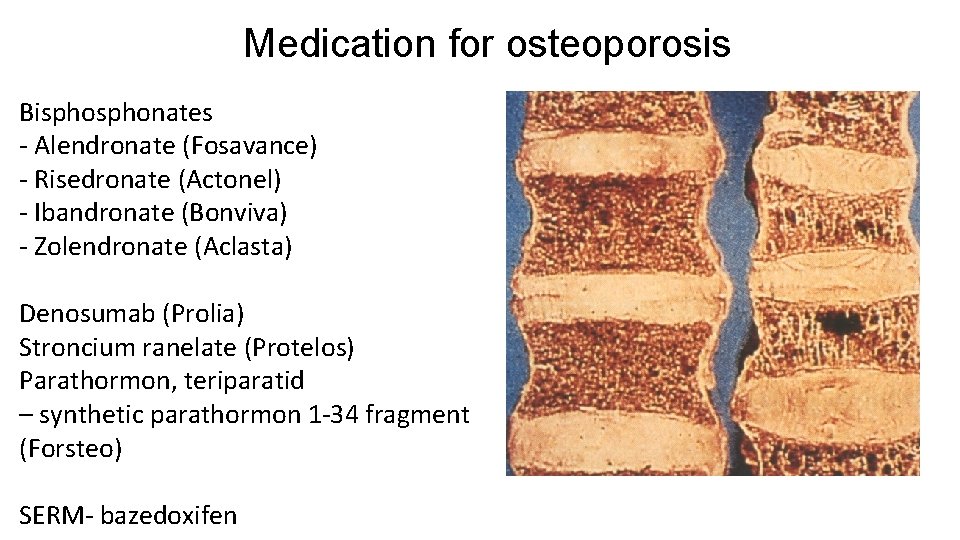 Medication for osteoporosis Bisphonates - Alendronate (Fosavance) - Risedronate (Actonel) - Ibandronate (Bonviva) -