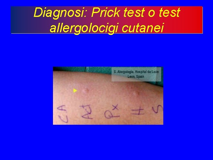 Diagnosi: Prick test o test allergolocigi cutanei 