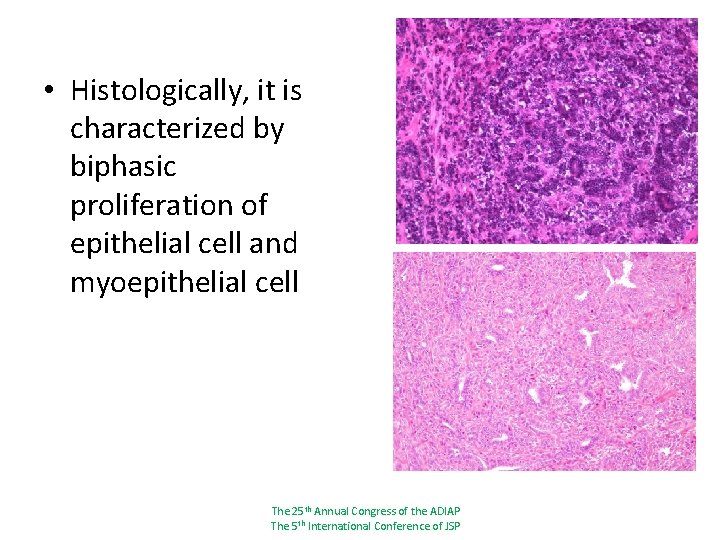 Malignant Adenomyoepithelioma of the Breast with Lymph Node
