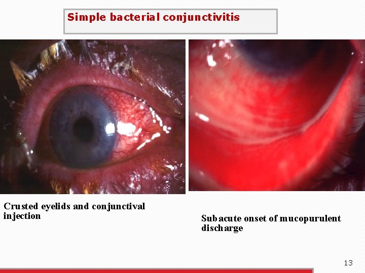 Simple bacterial conjunctivitis Crusted eyelids and conjunctival injection Subacute onset of mucopurulent discharge 13