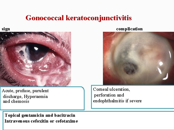Gonococcal keratoconjunctivitis sign Acute, profuse, purulent discharge, Hyperaemia and chemosis Topical gentamicin and bacitracin