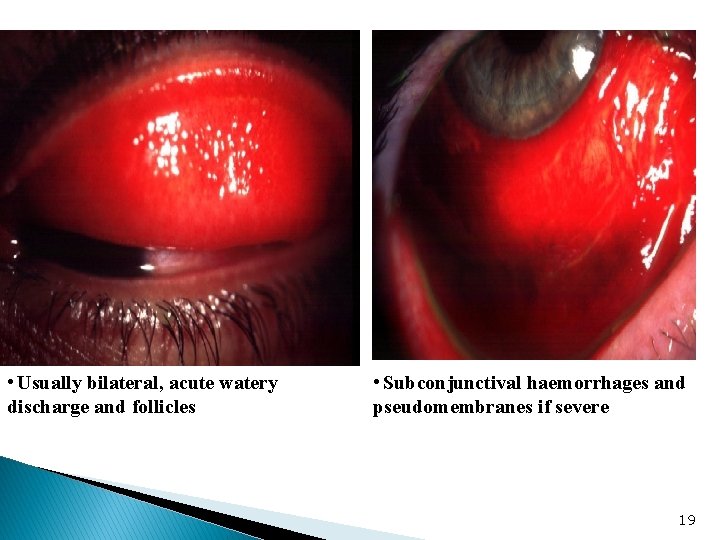  • Usually bilateral, acute watery discharge and follicles • Subconjunctival haemorrhages and pseudomembranes