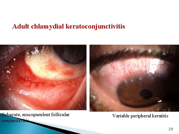 Adult chlamydial keratoconjunctivitis Subacute, mucopurulent follicular conjunctivitis Variable peripheral keratitis 29 