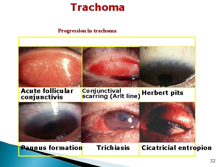 Trachoma Progression in trachoma Acute follicular conjunctivis Conjunctival Herbert pits scarring (Arlt line) Pannus