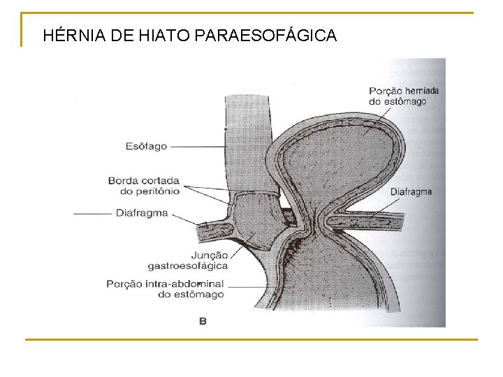 HÉRNIA DE HIATO PARAESOFÁGICA 