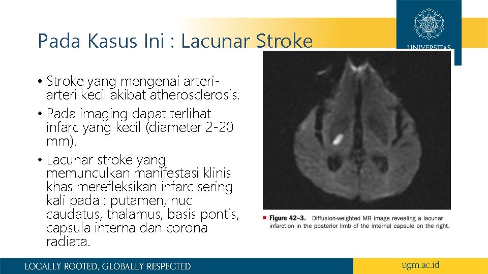 Pada Kasus Ini : Lacunar Stroke • Stroke yang mengenai arteri kecil akibat atherosclerosis.