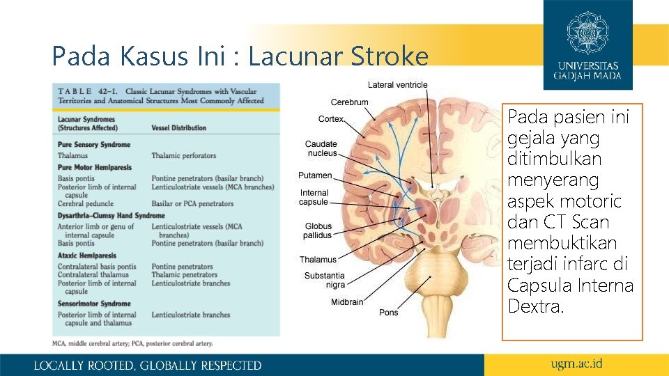 Pada Kasus Ini : Lacunar Stroke Pada pasien ini gejala yang ditimbulkan menyerang aspek