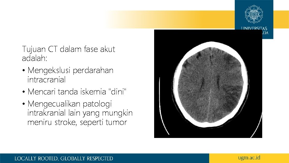 Tujuan CT dalam fase akut adalah: • Mengekslusi perdarahan intracranial • Mencari tanda iskemia