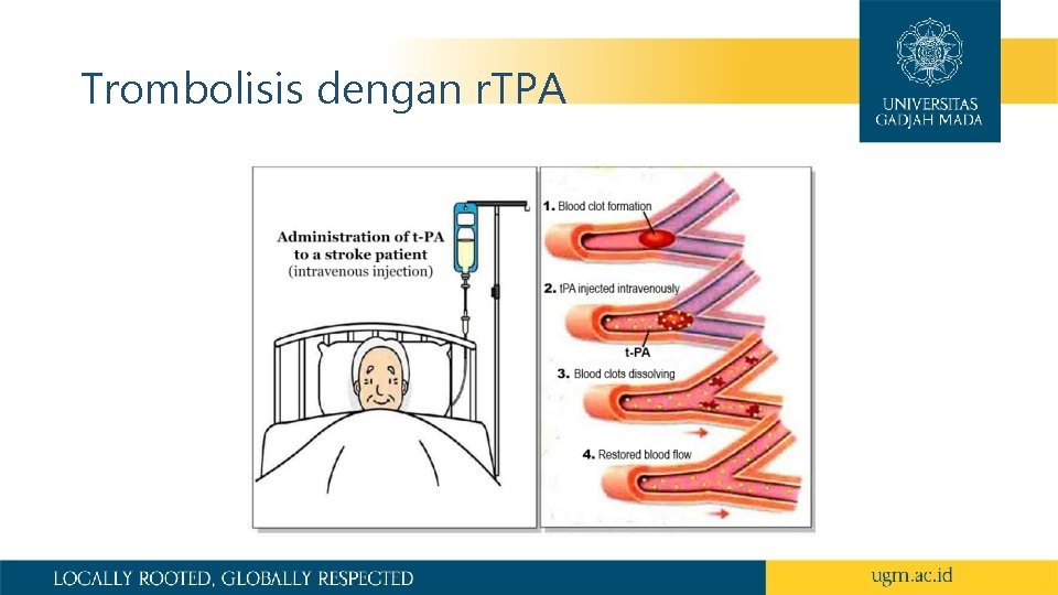 Trombolisis dengan r. TPA 