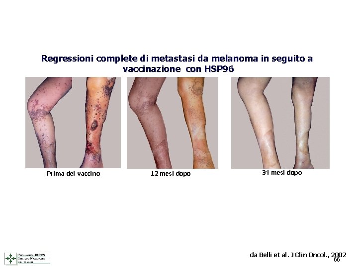 Regressioni complete di metastasi da melanoma in seguito a vaccinazione con HSP 96 Prima