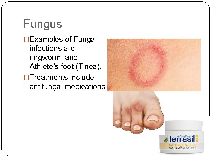 Fungus �Examples of Fungal infections are ringworm, and Athlete’s foot (Tinea). �Treatments include antifungal