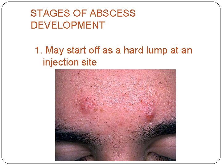 STAGES OF ABSCESS DEVELOPMENT 1. May start off as a hard lump at an