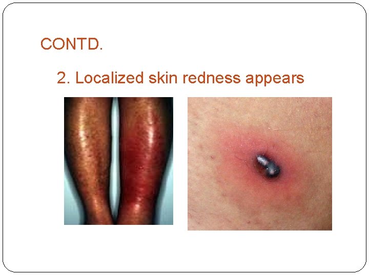 CONTD. 2. Localized skin redness appears 