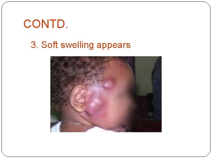 CONTD. 3. Soft swelling appears 