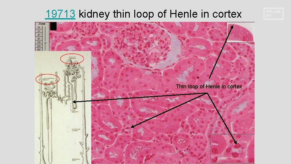 19713 kidney thin loop of Henle in cortex Thin loop of Henle in cortex