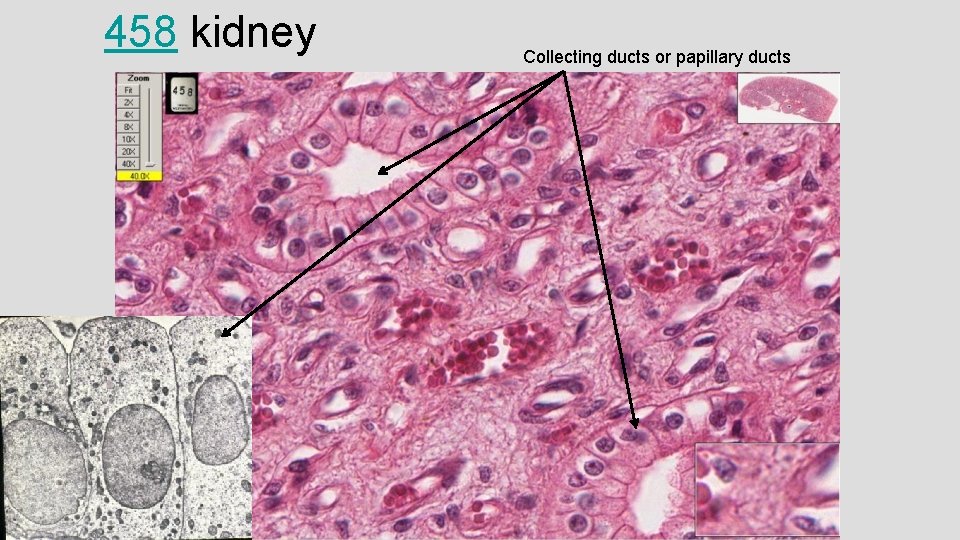 458 kidney Collecting ducts or papillary ducts 