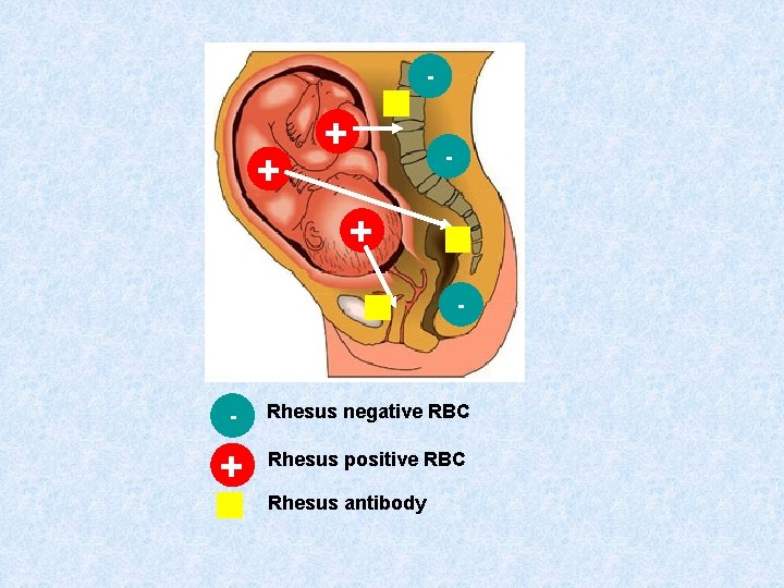 - + + - - Rhesus negative RBC + Rhesus positive RBC Rhesus antibody