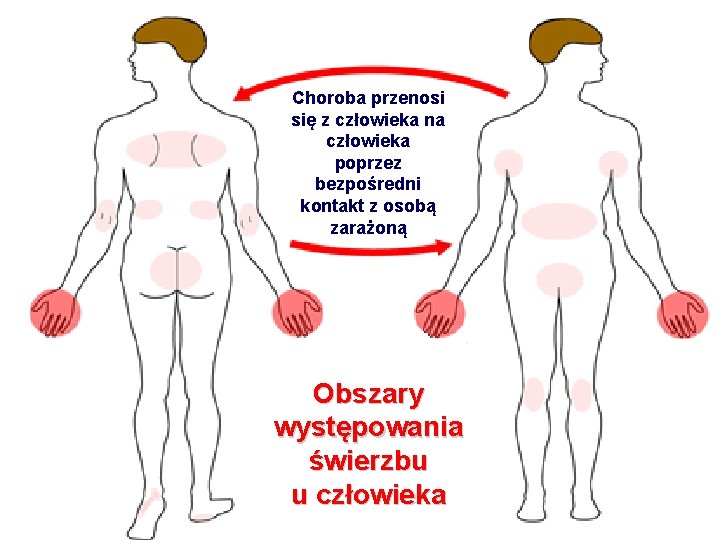 Choroba przenosi się z człowieka na człowieka poprzez bezpośredni kontakt z osobą zarażoną Obszary