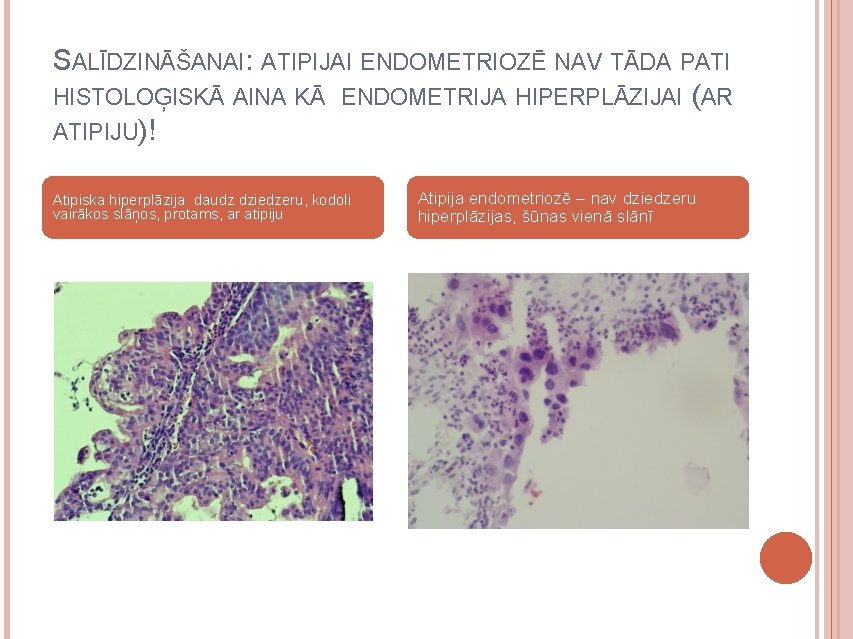 SALĪDZINĀŠANAI: ATIPIJAI ENDOMETRIOZĒ NAV TĀDA PATI HISTOLOĢISKĀ AINA KĀ ENDOMETRIJA HIPERPLĀZIJAI (AR ATIPIJU)! Atipiska