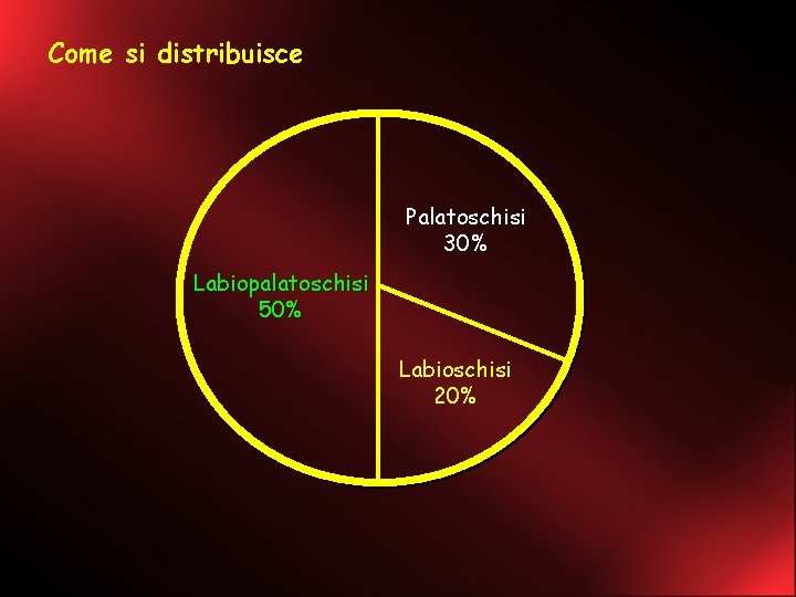 Come si distribuisce Palatoschisi 30% Labiopalatoschisi 50% Labioschisi 20% 