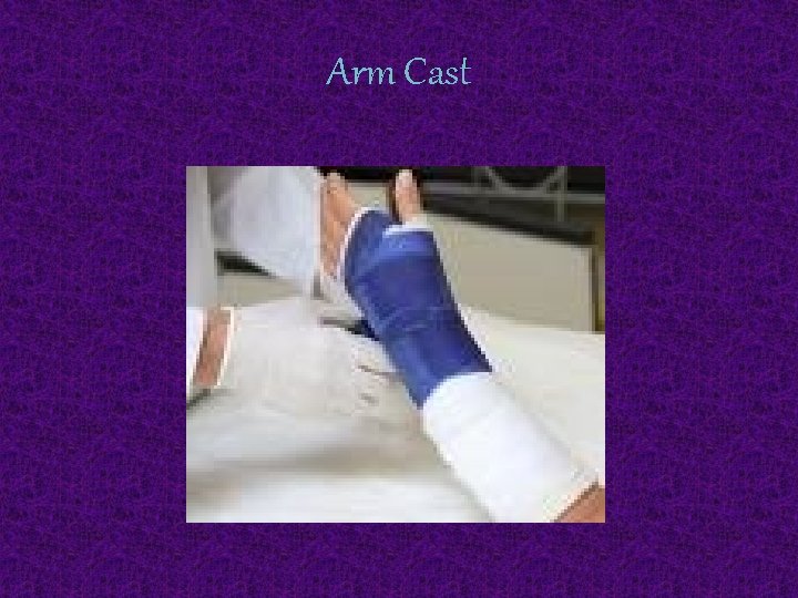 Arm Cast 