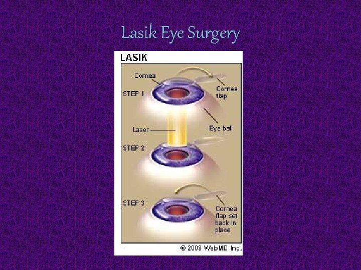 Lasik Eye Surgery 