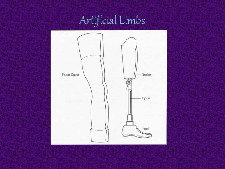 Artificial Limbs 