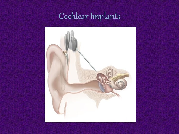 Cochlear Implants 